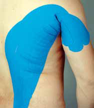 Blaues Kinesiology-Tape entlang des Latissimus dorsi am Rücken und Oberarm