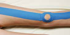 Fertig angelegtes blaues Kinesiology-Tape über dem Kniegelenk