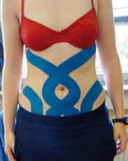 Rot-blaues Kinesiology-Tape am Bauch in Abdomen-Tape-Muster