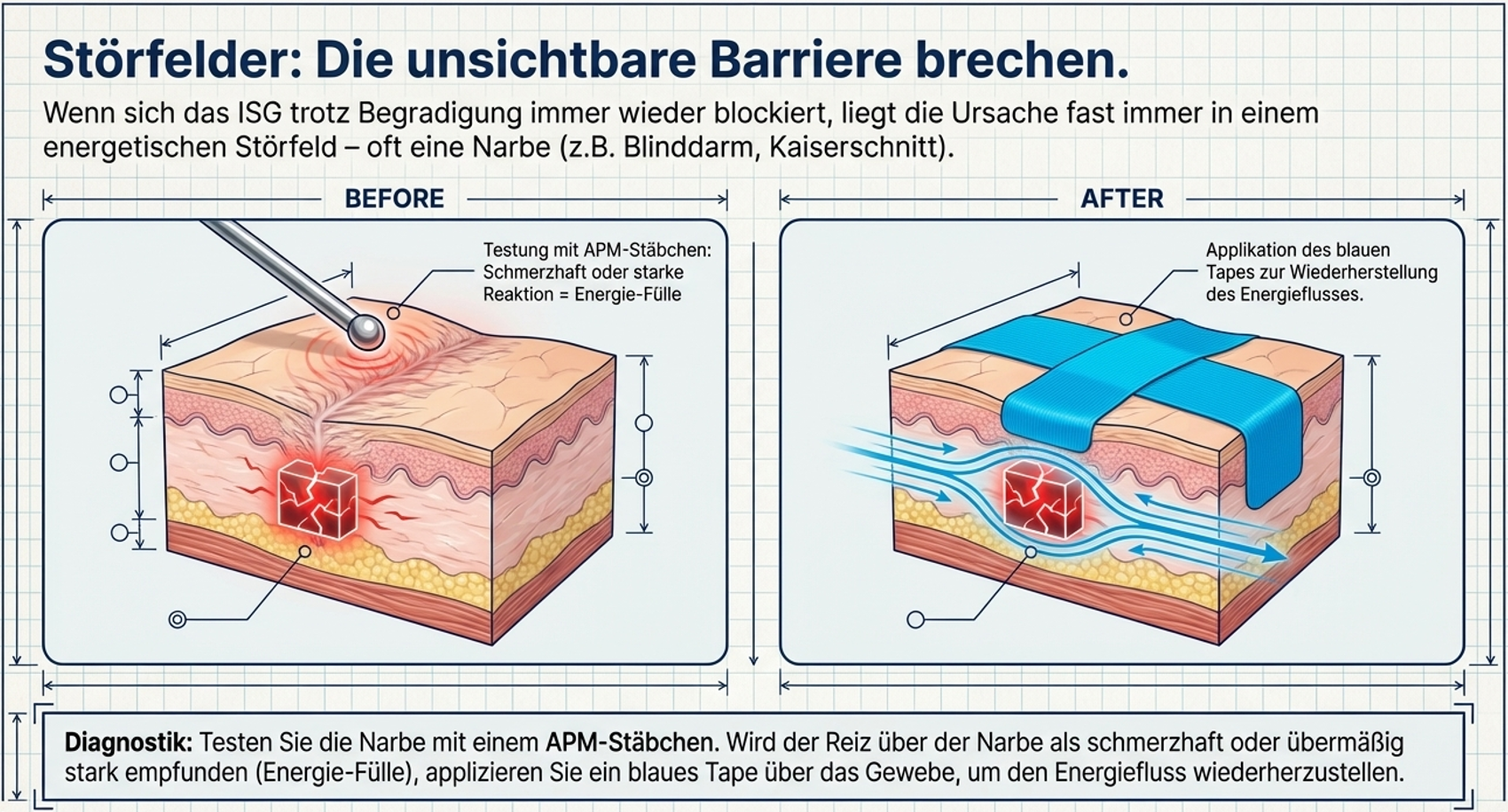 Anwendung Medi-Taping Methode Dr. Sielmann Rücken Taping energetische Begleitung